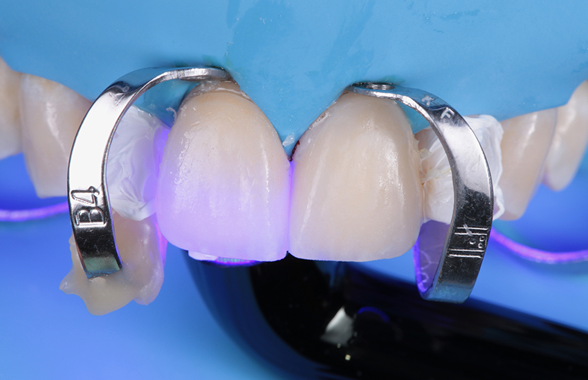 Lichthärtung. Bilder mit freundlicher Genehmigung von Dr. Paulo Monteiro.